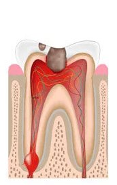 Dental Infection