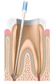 Removal of infected tissues