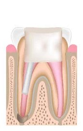 Filling placement & optional post