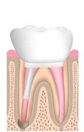 Placement of a dental crown